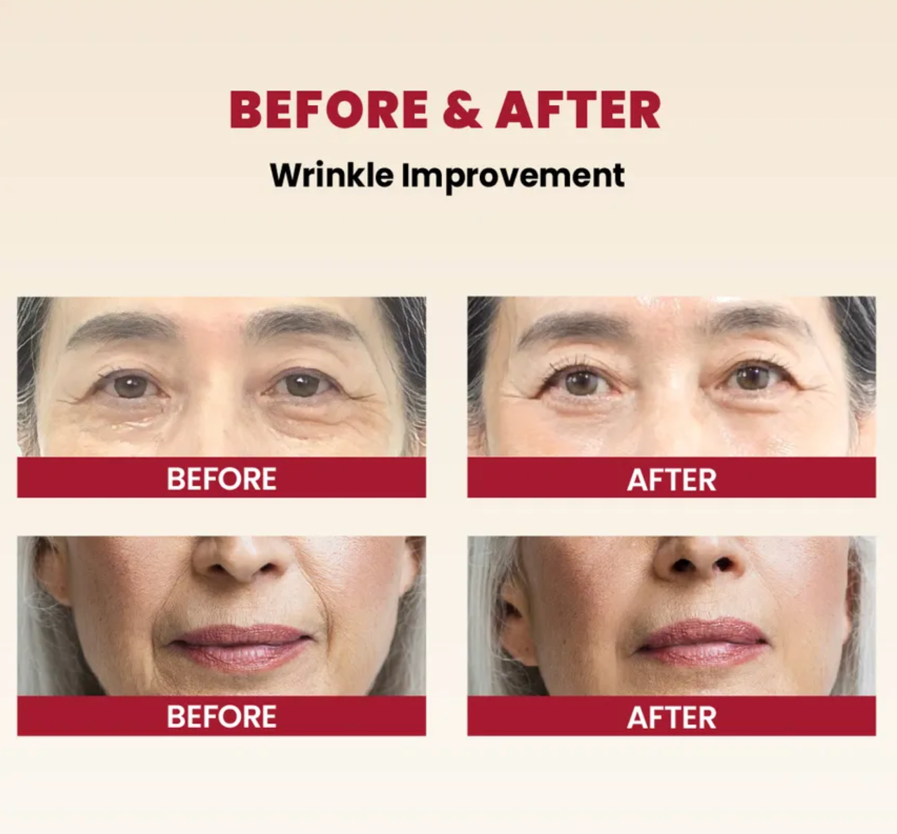 Before and after comparison of wrinkle improvement on a person's face.
