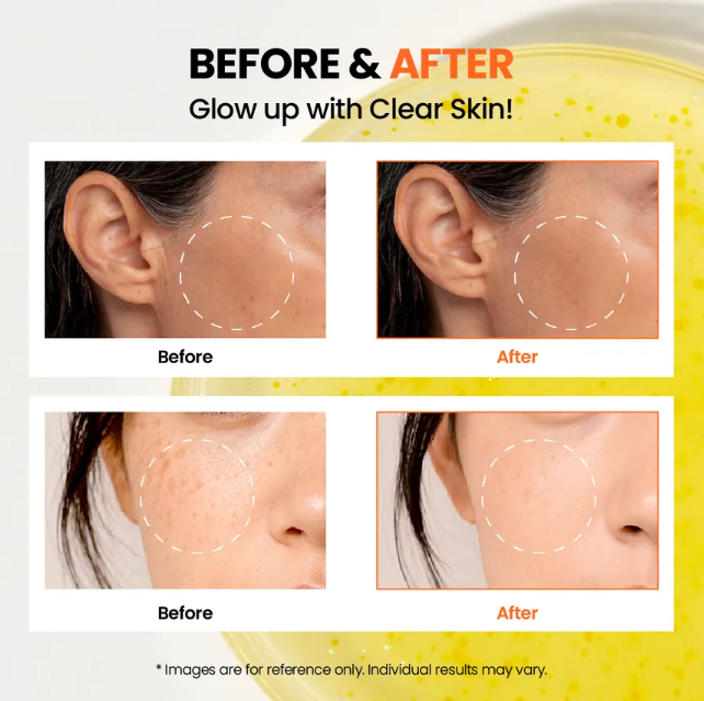 Before and after comparison of clear skin on a person's face with text 'Before & After Glow up with Clear Skin!'.
